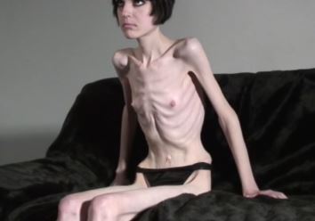 Anorecia Porn - Anorexic